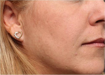 Restylane