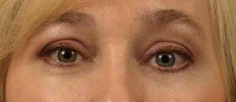 Lower Eyelid/Tear-Trough Restyalne