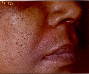 Restylane/Juvederm