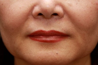 Fill the nasolabial folds and marionette lines