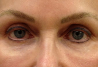 Tear trough filler