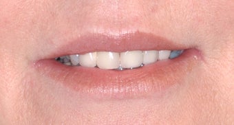 Smokers lines treated with Restylane and Botox in lips