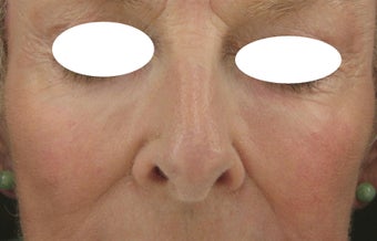 Midface, Cheeks, Tear troughs, and Nasolabial folds treated Restylane and Radiesse