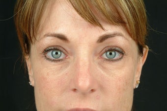 Restylane