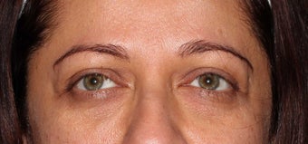 Undereye Filler Injection