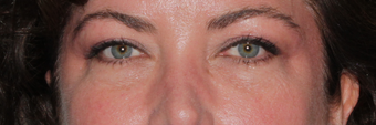 Restylane