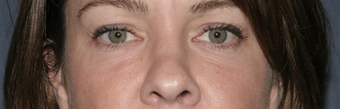 Restylane