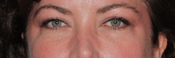 Restylane
