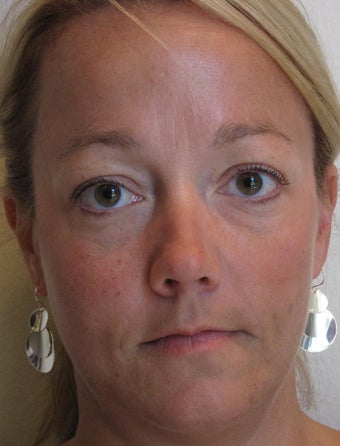 Dermal Filler