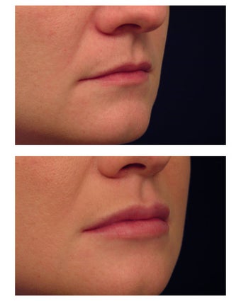 Restylane for lip augmentation