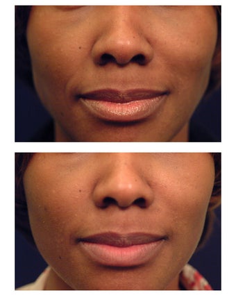 Restylane