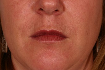 Restylane treatment