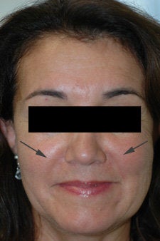 Restylane treatment for laugh lines  