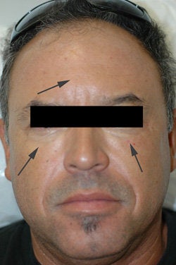 Restylane for dark circles under the eyes