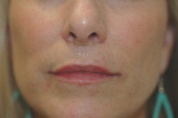 Restylane Treatment for lips