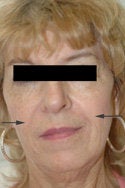 Restylane injections for laugh lines
