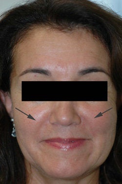 Restylane for laugh lines 