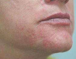 Chin rejuvenation 