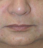 Restylane for marionette (mouth) lines
