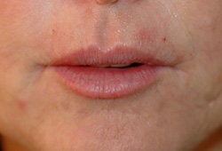 Restylane injections for upper lip lines 