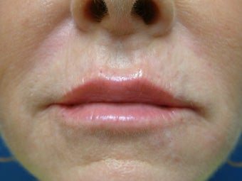 Restylane (Filler)