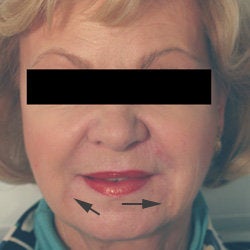 Oral Commissures (marionette lines) with Restylane Treatment