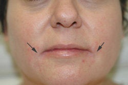 Restylane and Botox for mouth rejuvenation