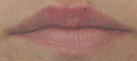 Lip enhancement with Restylane