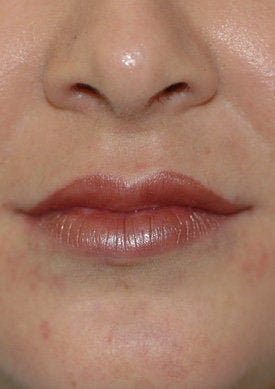 Restylane lip injections