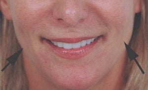 Restylane for cheek augmentation