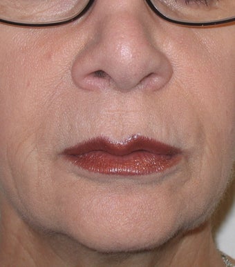 Restylane Treatment for Lips and Nasolabial Folds