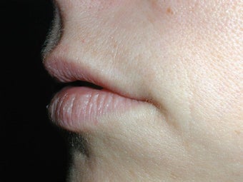 Restylane for upper lip