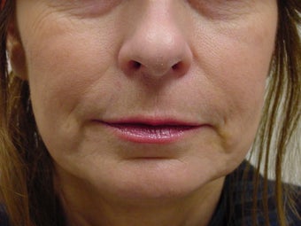 Restylane treatment for marionette lines 