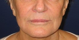 Restylane injection into lips and nasolabial folds