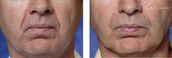 Restylane (Filler)