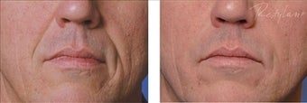 Restylane