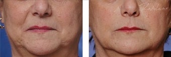 Restylane