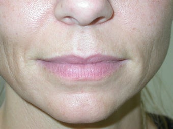 Filler -lip augmentation and smile line treatment