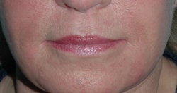 Lip Augmentation with Restylane