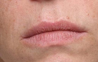 Lip treatment with Restylane®