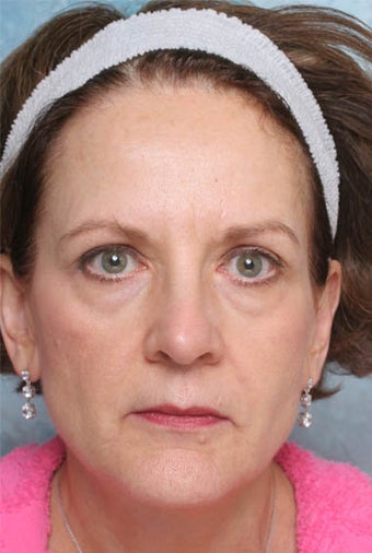 Undereye Deepfill Restylane® and Perioral Perlane®