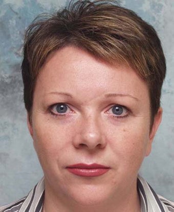 Microdroplet BOTOX® and Deepfill Restylane®