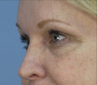 Restylane under Eyes