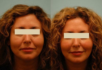 Injectable Fillers (Restylane/Perlane)