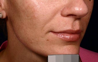 Restylane