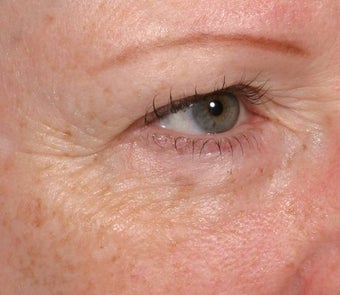Resytlane under eyes