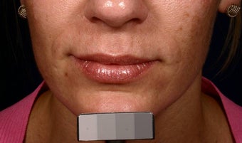 Restylane