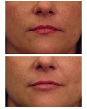 Injectable Filler