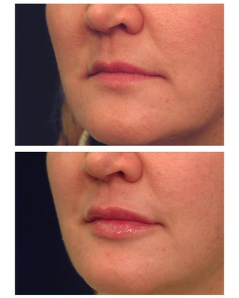 Restylane