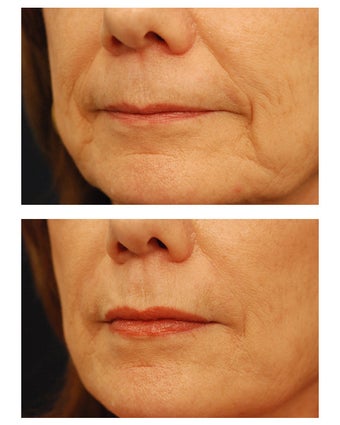 Restylane